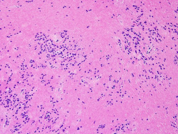 14A3 Subependymoma (W13-3516) H&E 1