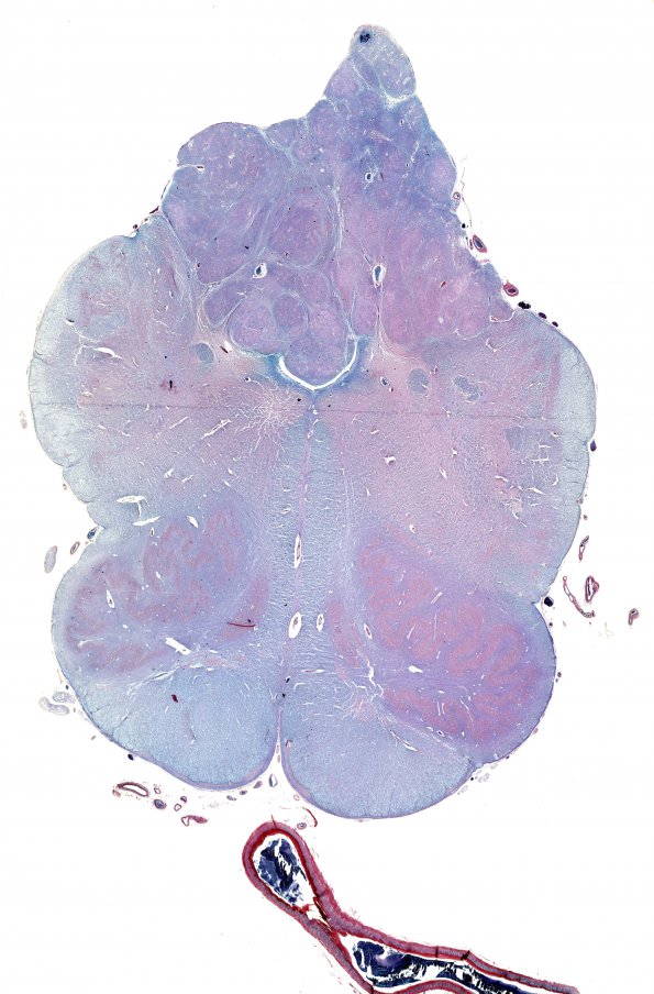 15A2 Subependymoma (Unlabeled PTAH) WM