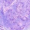 15A3 Subependymoma (Unlabeled PTAH) 20X