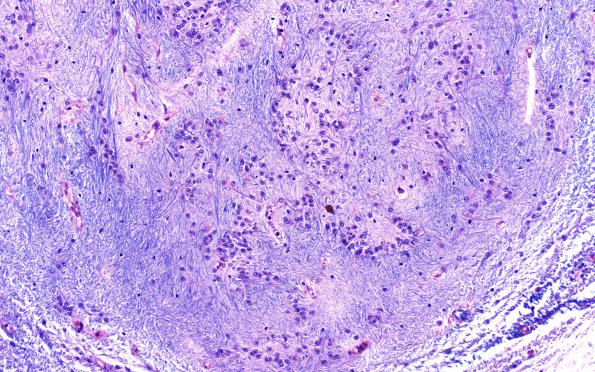 15A3 Subependymoma (Unlabeled PTAH) 20X