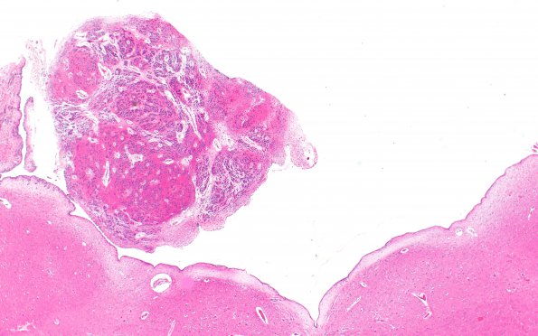 16A1 Subependymoma (A39543) IV Ventricle H&E 2X