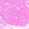 16A2 Subependymoma (A39543) IV Ventricle H&E 10X