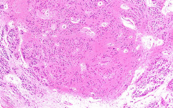 16A2 Subependymoma (A39543) IV Ventricle H&E 10X