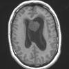 17A1 Subependymoma (Case 17) T1noC