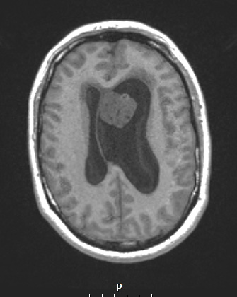 17A1 Subependymoma (Case 17) T1noC