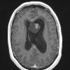 17A2 Subependymoma (Case 17) T1W