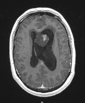 17A2 Subependymoma (Case 17) T1W