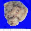 17B1 Subependymoma (Case 17) Gross_1