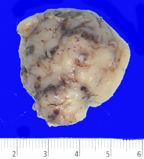 17B1 Subependymoma (Case 17) Gross_1