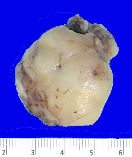 17B2 Subependymoma (Case 17) Gross_2