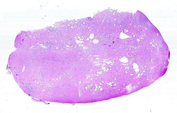 17C1 Subependymoma (Case 17) H&E WM A
