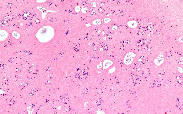 17C3 Subependymoma (Case 17) H&E 10X