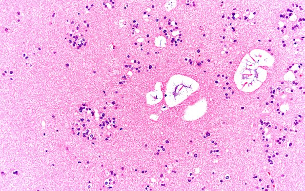 17C4 subependymoma (Case 17) H&E 20X