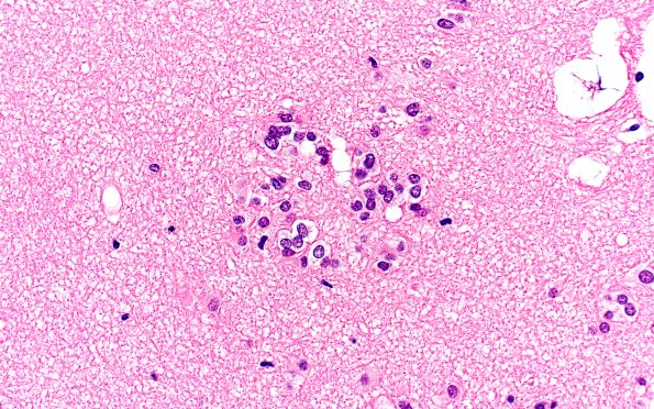 17C5 Subependymoma (Case 17) H&E 40X