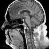 18A1 Subependymoma (Case 18) FL2D - Copy