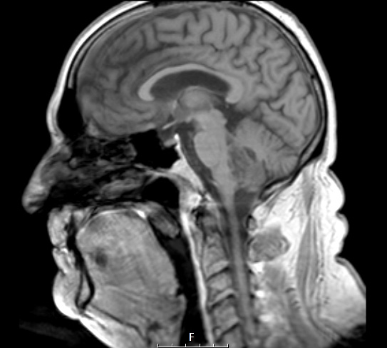 18A1 Subependymoma (Case 18) FL2D - Copy