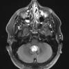 18A2 Subependymoma (Case 18) T2W - Copy