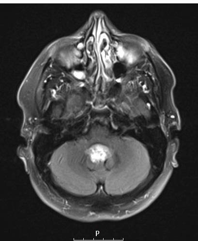 18A2 Subependymoma (Case 18) T2W - Copy