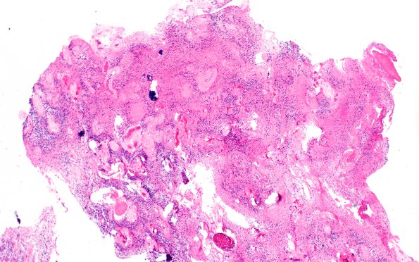 18B1 Subependymoma (Case 18) H&E 4X