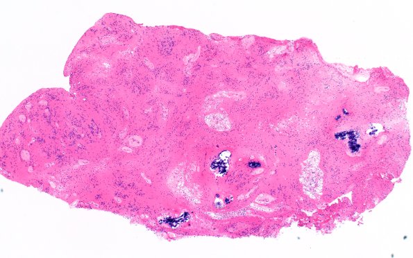 18B2 Subependymoma (Case 18) H&E 4X 2