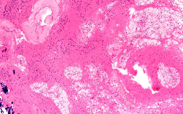 18B3 Subependymoma (Case 18) H&E 10X 2