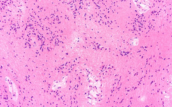18B5 Subependymoma (Case 18) H&E 20X 4