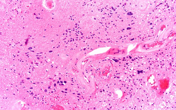 18B6 Subependymoma (Case 18) H&E 20X 6