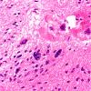 18B7 Subependymoma (Case 18) H&E 40X