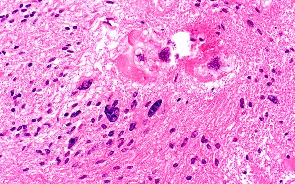 18B7 Subependymoma (Case 18) H&E 40X