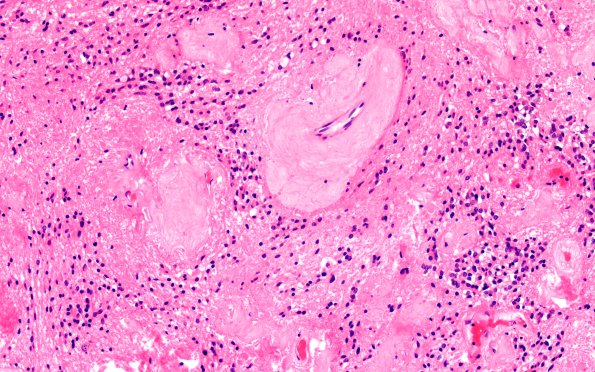 18B8 Subependymoma (Case 18) H&E 20X