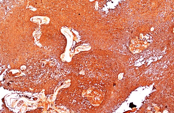 18C1 Subependymoma (Case 18) GFAP 10X B