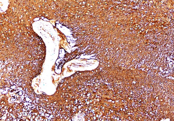 18C2 Subependymoma (Case 18) GFAP 20X B