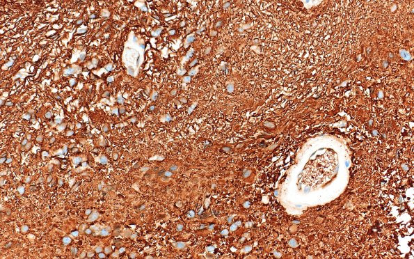 18C3 Subependymoma (Case 18) GFAP 40X