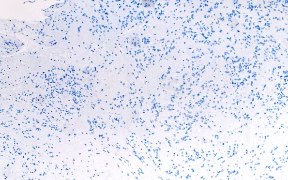 18F Subependymoma (Case 18) Ki67 10X 2