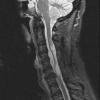 1A Subependymoma (Case 1) STIR - Copy