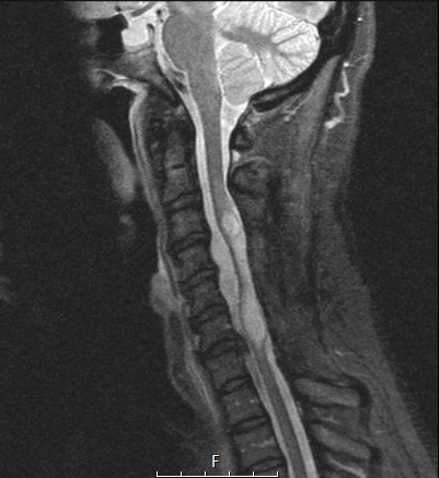 1A Subependymoma (Case 1) STIR - Copy