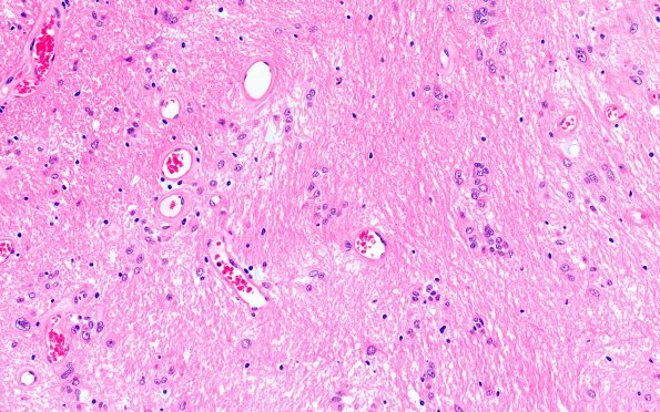 1B2 Subependymoma, spinal (Case 1) H&E 20X