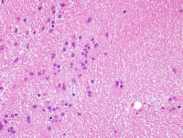 1B3 Subependymoma, spinal (Case 1) H&E 12