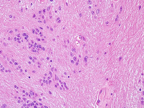 1B4 Subependymoma, spinal (Case 1) H&E 13