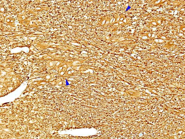 1C Subependymoma, spinal (Case 1) GFAP 4 copy