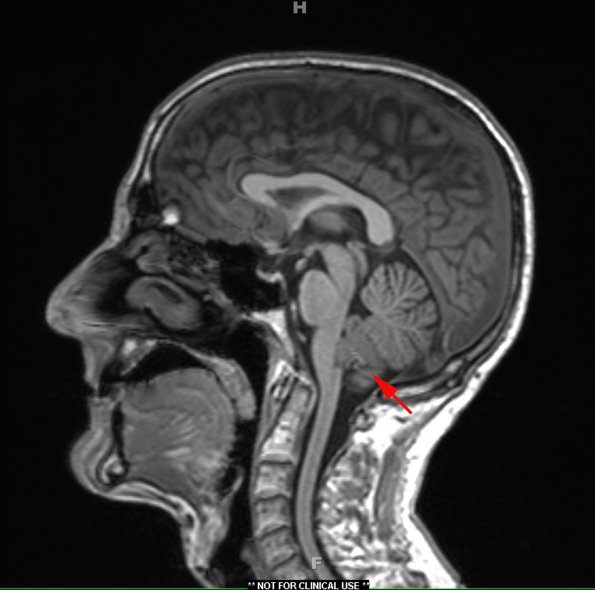 2A1 Subependymoma (Case 2) T1 MPRAGE 1 - Copy copy