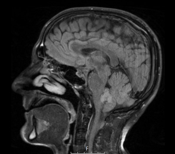 2A2 Subependymoma (Case 2) TIRM 2 - Copy