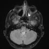 2A3 Subependymoma (Case 2) TIRM - Copy