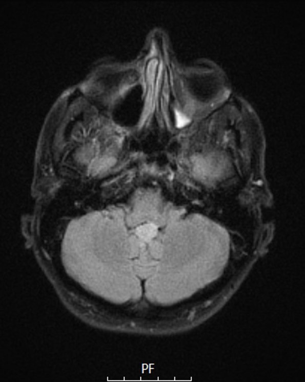 2A3 Subependymoma (Case 2) TIRM - Copy