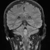 2A4 Subependymoma (Case 2) TIRM 2 - Copy