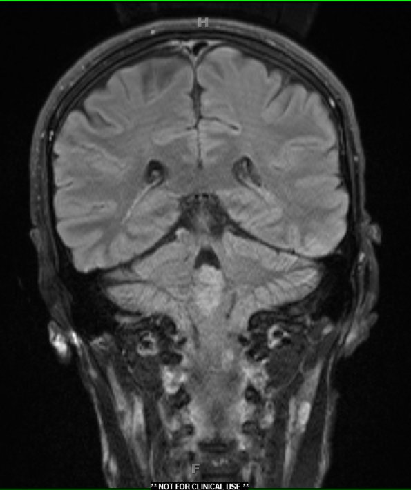 2A4 Subependymoma (Case 2) TIRM 2 - Copy