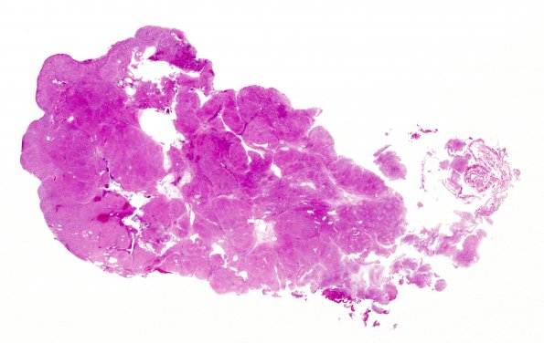 2C1 Subependymoma (Case 2) H&E WM 2