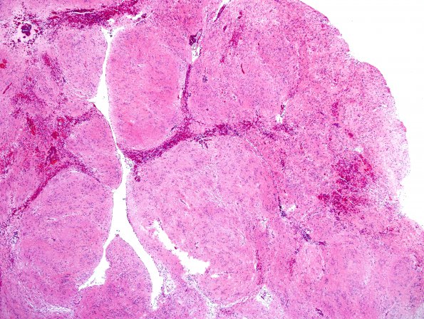 2C2 Subependymoma (Case 2) H&E 14