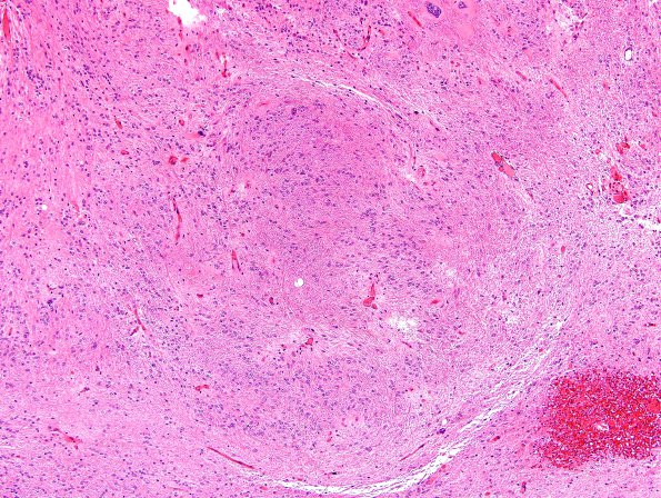 2C3 Subependymoma (Case 2) H&E 22