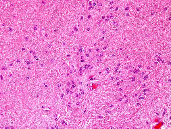 2C4 Subependymoma (Case 2) H&E 1